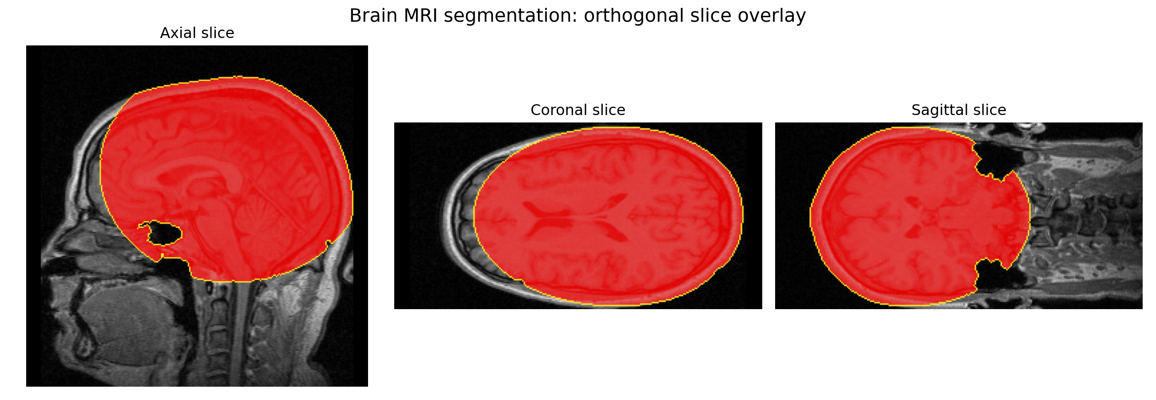 Brain MRI segmentation overlay in axial, coronal, and sagittal views